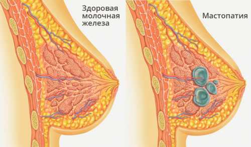 Основным методом выявления болезней груди является регулярный осмотр маммологом или онкологом