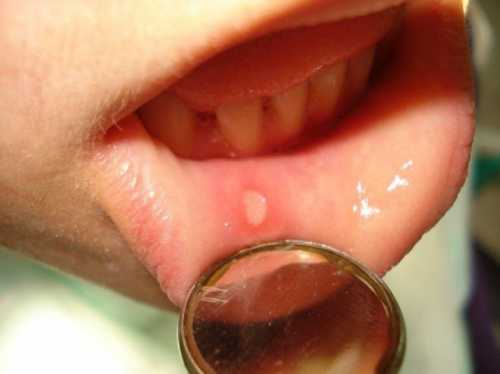 Гдето на третьи сутки после начала заболевания на языке и внутренней поверхности щёк появляется серовато белый налет, который со временем перекочевывает на слизистую губ и даже в уголки рта