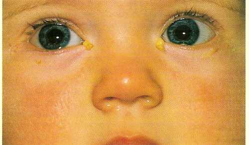Правила закапывания капель в глаз ребенка